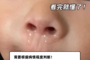 三岁宝宝流鼻涕一个月了怎么办_反复流鼻涕的原因