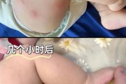 宝宝身上长包怎么回事_宝宝身上长包怎么办