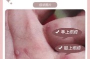 3岁宝宝手足口病初期症状_手足口病怎么治疗