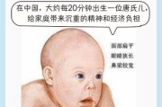 唐宝宝是什么意思_唐氏综合征儿童特征
