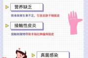 宝宝手指头脱皮是怎么回事_宝宝手指脱皮缺什么