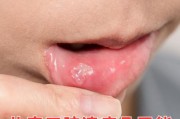 宝宝喉咙溃疡图片_喉咙溃疡怎么办