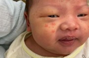 宝宝两边脸颊长小红点_怎么办