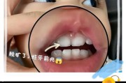宝宝牙齿缺口怎么回事_宝宝牙齿缺口怎么办