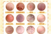 皮肤图片大全_如何辨别常见皮肤病