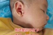 宝宝附耳切除最佳年龄_附耳手术费用大概多少钱