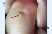 宝宝剑突突出正常吗_新生儿剑突骨图片怎么看