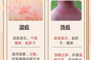 宝宝热疹子图片_热疹和湿疹区别