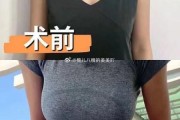 丰胸图片大全_真实效果对比图可信吗
