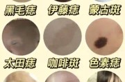 胎记图片大全_胎记类型有哪些