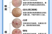 粉刺图片大全_粉刺怎么区分类型