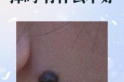 2岁宝宝脸上为什么突然长痣_婴儿色素痣会自己消失吗