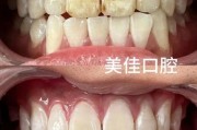美牙图片大全_美牙前后对比真实案例