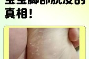宝宝脚脱皮怎么回事_婴儿脚部脱皮原因