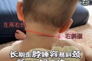 宝宝斜颈症状有哪些_婴儿斜颈怎么判断