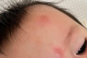 宝宝蚊虫叮咬过敏怎么办_宝宝被蚊子咬了红肿很大怎么办