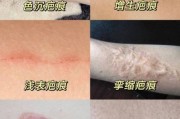 伤痕图片大全_如何分辨新旧伤疤