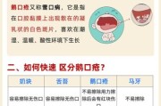 宝宝鹅口疮怎么办_鹅口疮反复发作怎么处理