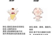 3岁宝宝湿疹反复怎么办_日常护理全攻略