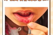 2岁宝宝口腔溃疡怎么办_家庭护理小妙招