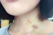 锁骨草莓印怎么消除_草莓印多久能消