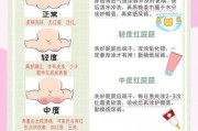 宝宝红屁股怎么办_新生儿尿布疹图片识别