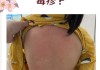 宝宝病毒性疙瘩图片_如何辨别与护理