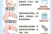 宝宝红屁屁怎么办_新生儿红屁屁图片解析