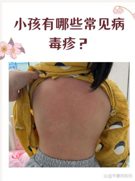 宝宝病毒性疙瘩图片_如何辨别与护理