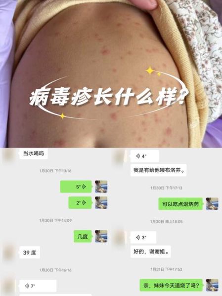 宝宝病毒性疙瘩图片_如何辨别与护理