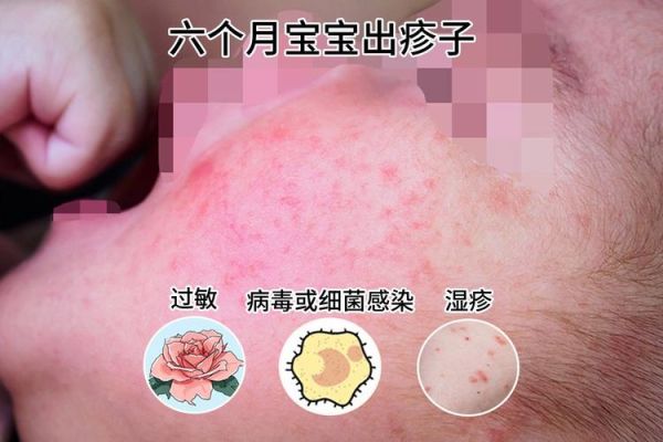 宝宝杨棉过敏症状_怎么快速缓解