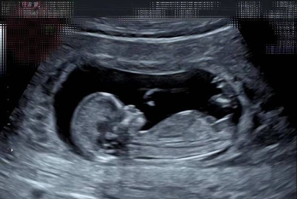 B超男女宝宝区别图怎么看_B超单数据辨别男女技巧