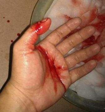 梦见手出血是什么意思_梦见手受伤代表什么