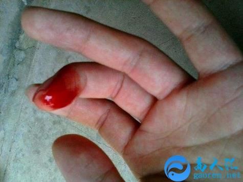 梦见手出血是什么意思_梦见手受伤代表什么
