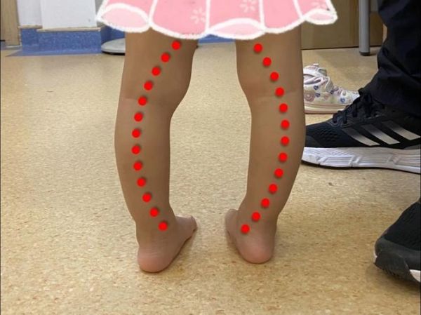 宝宝2岁还不会走路_正常吗