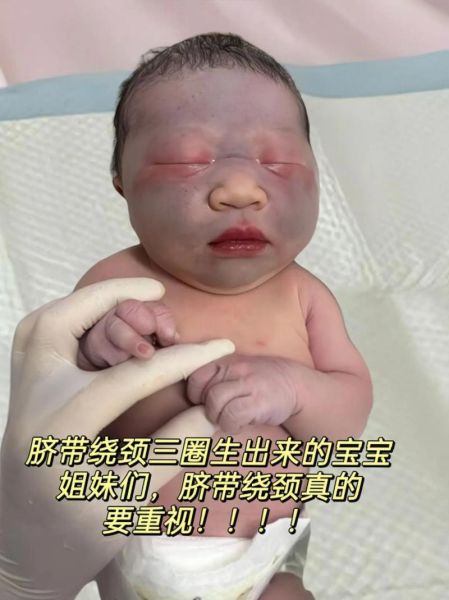 宝宝脐带绕颈怎么办_脐带绕颈一周能顺产吗