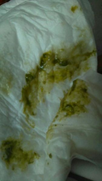 宝宝大便绿色有奶瓣怎么回事_需要看医生吗