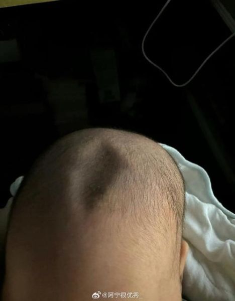 宝宝发烧卤门鼓起怎么回事_需要立即就医吗