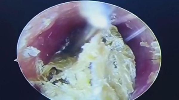 梦到扣耳屎是什么意思_梦见掏耳朵预示什么