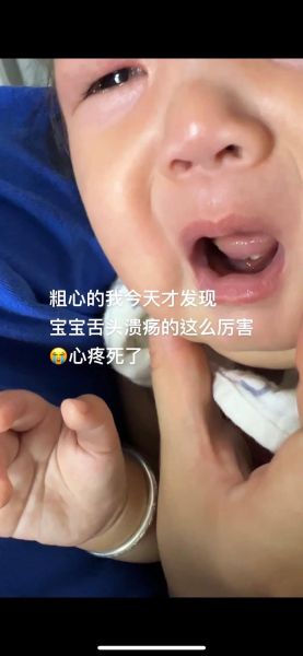 四个月宝宝口腔溃疡图_怎么快速缓解