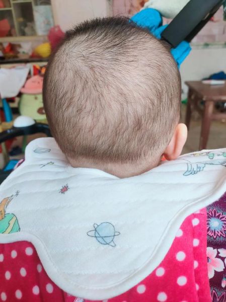 三个月宝宝枕秃正常吗_如何改善