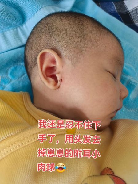 宝宝附耳切除最佳年龄_附耳手术费用大概多少钱