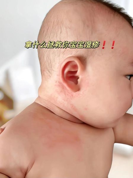 宝宝热痱子症状图片_怎么快速消退