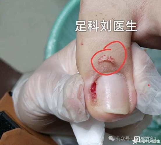 宝宝甲沟炎化脓怎么办_甲沟炎化脓能自愈吗