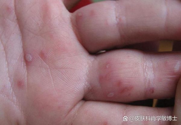 五岁宝宝手上长水泡怎么办_会不会传染