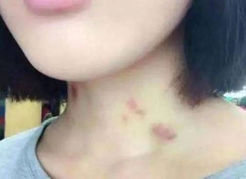 锁骨草莓印怎么消除_草莓印多久能消