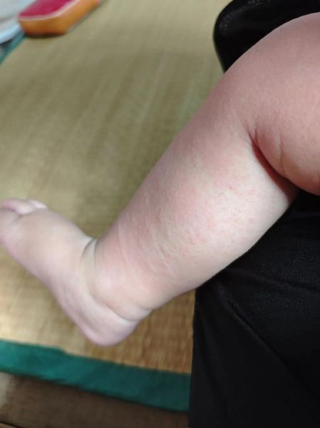 宝宝酒精过敏症状_酒精过敏图片怎么看