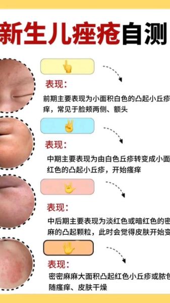 宝宝长痘痘有几种图片_新生儿痤疮和湿疹区别图