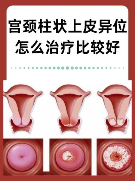 宫颈图片大全_正常与病变对比图怎么看