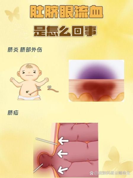 满月宝宝肚脐出血怎么办_满月宝宝肚脐出血正常吗